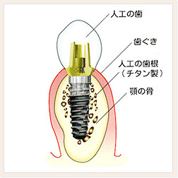 インプラントとは