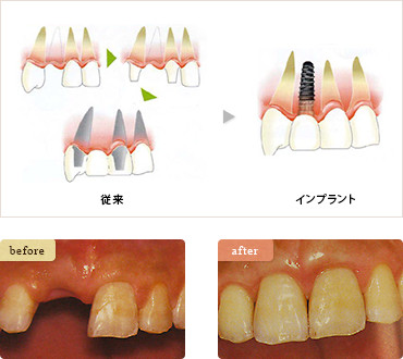 前歯を1本失った場合