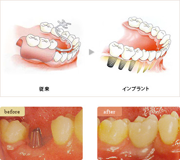 奥歯を1本失った場合