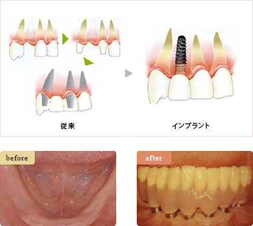 すべての歯を失った場合