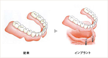 総入れ歯が安定しない場合