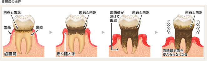 歯周病は感染症です